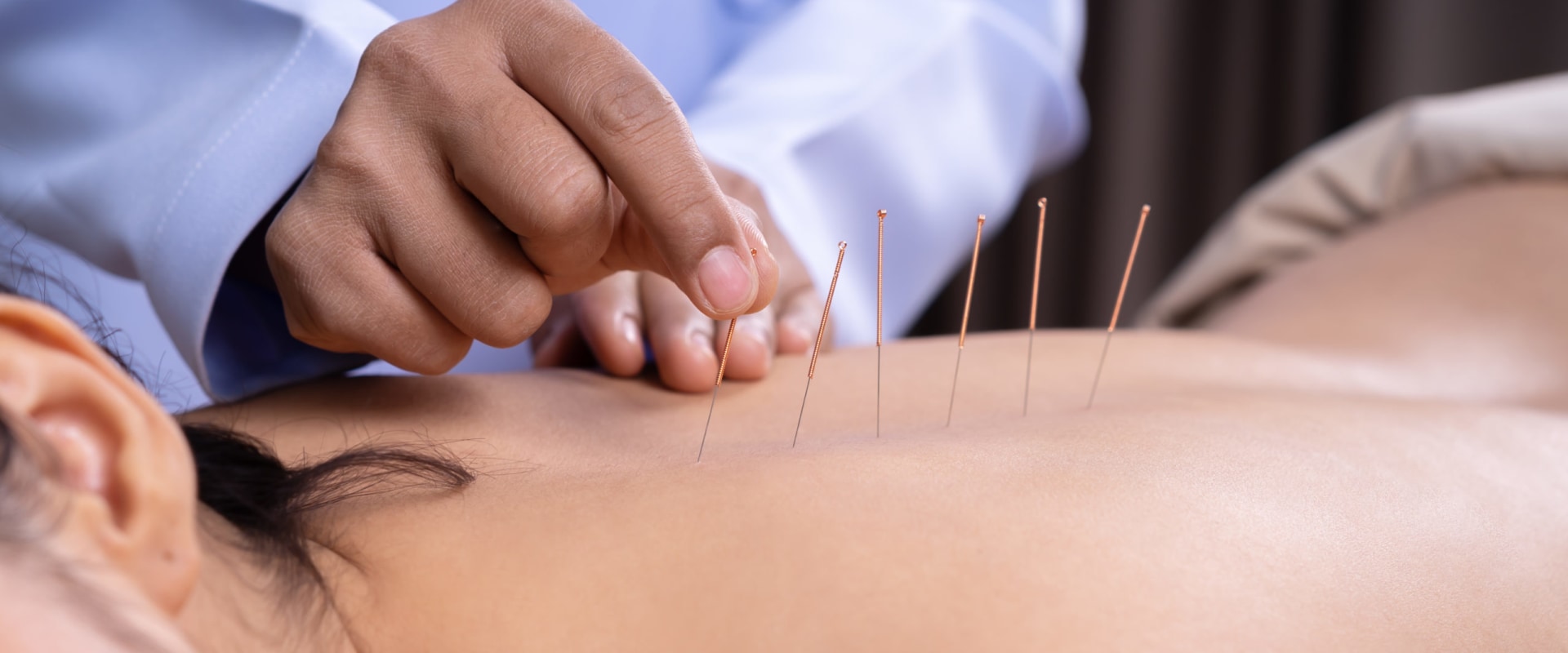 What to Expect During an Acupuncture Session