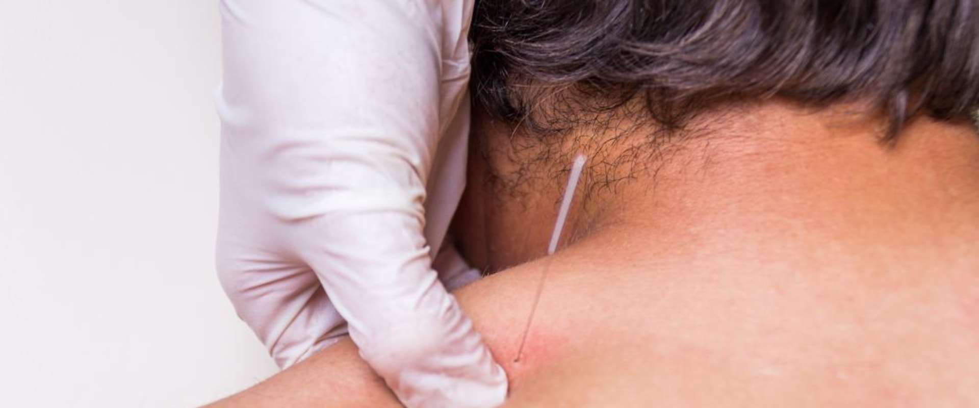 Acupuncture vs Dry Needling: What's the Difference?