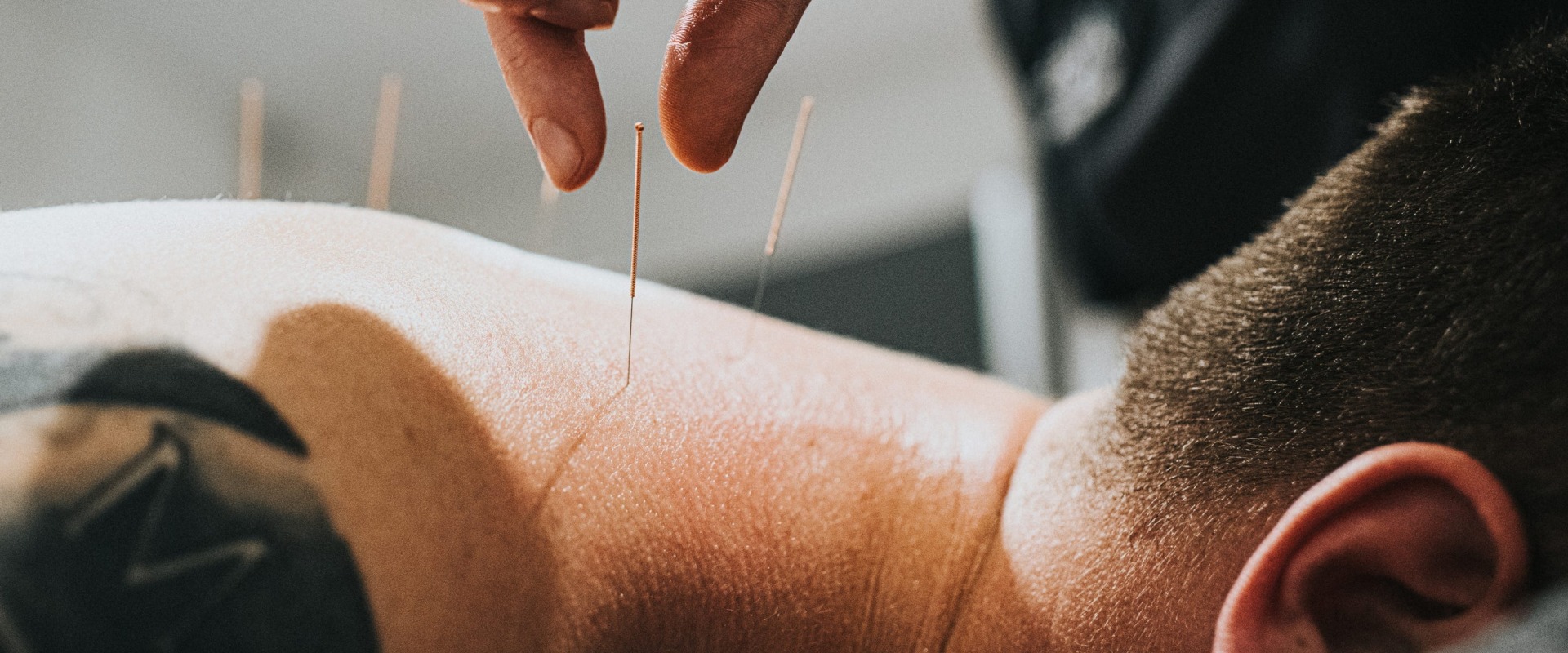 Unlock the Benefits of Acupuncture: 3 Reasons to Try It