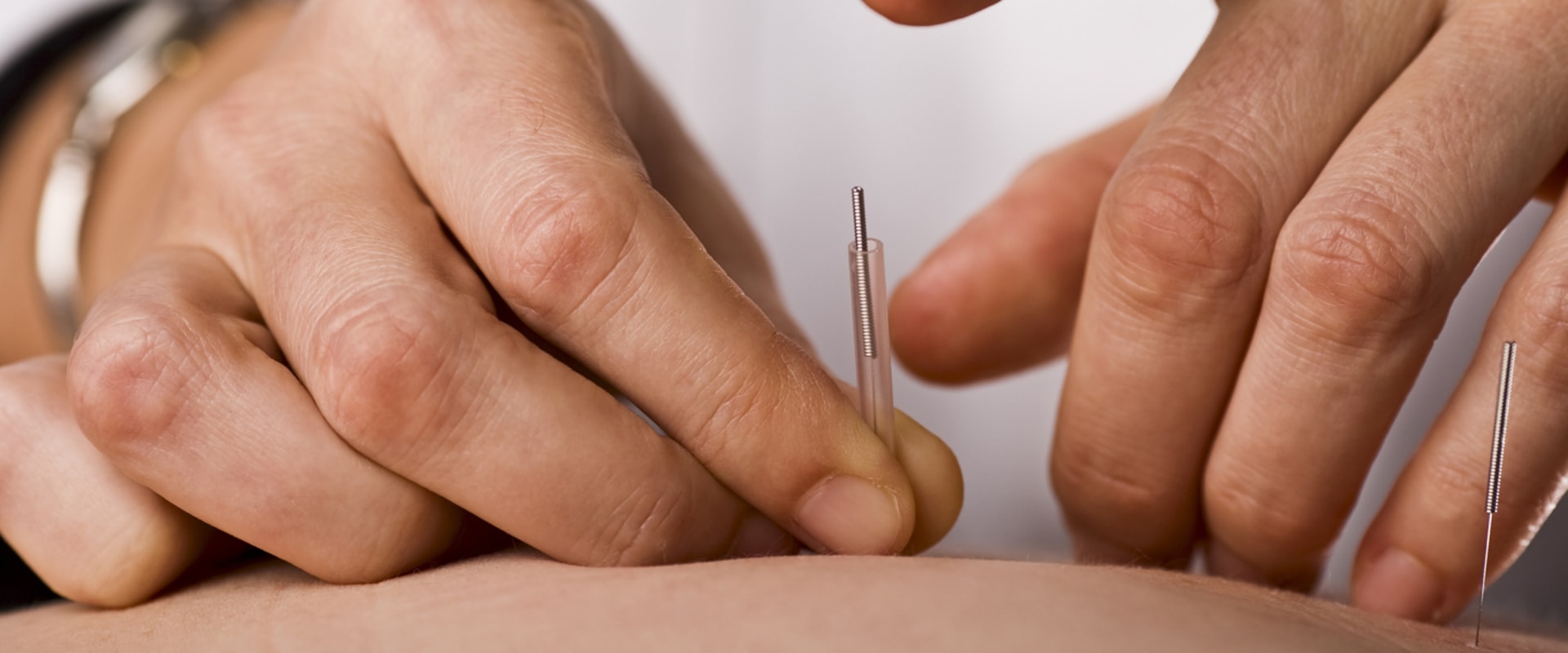 Can Children Receive Acupuncture Treatments?