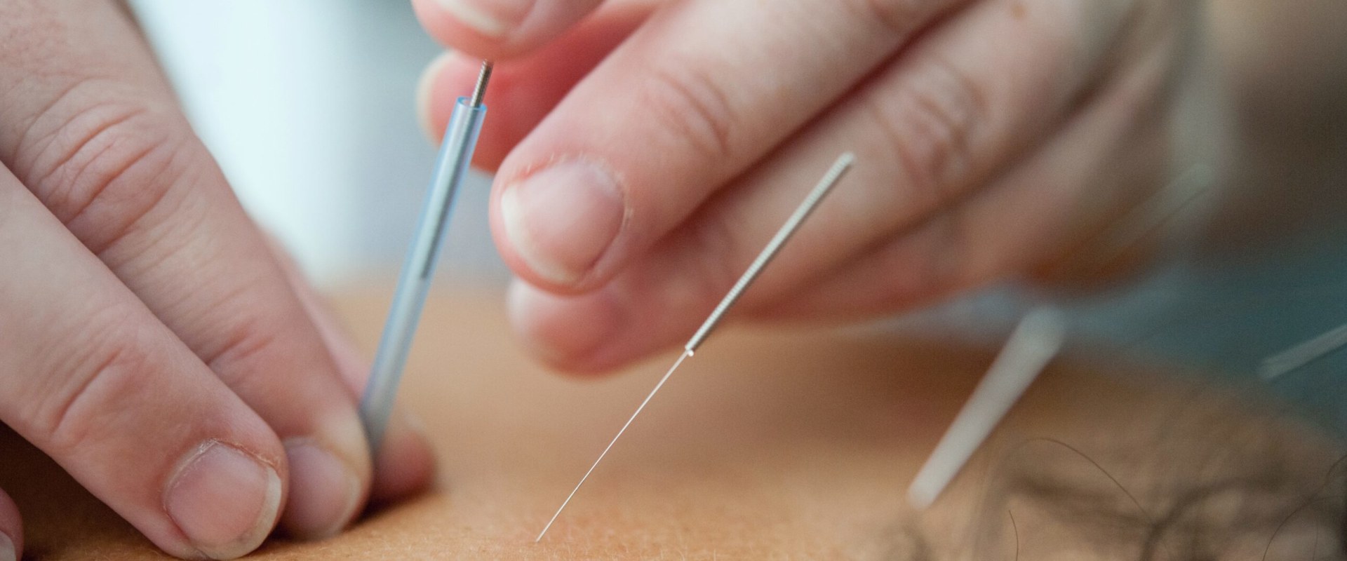 Exploring Alternative Therapies to Enhance Acupuncture Treatments