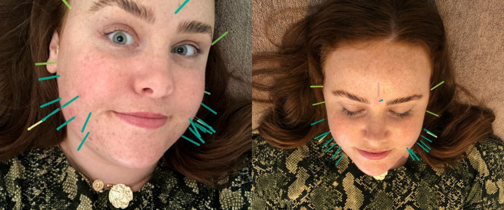 How Long Does it Take to See Results from Acupuncture Treatment?