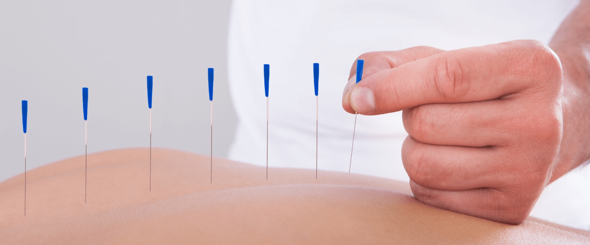 The Benefits of Acupuncture: A Comprehensive Guide