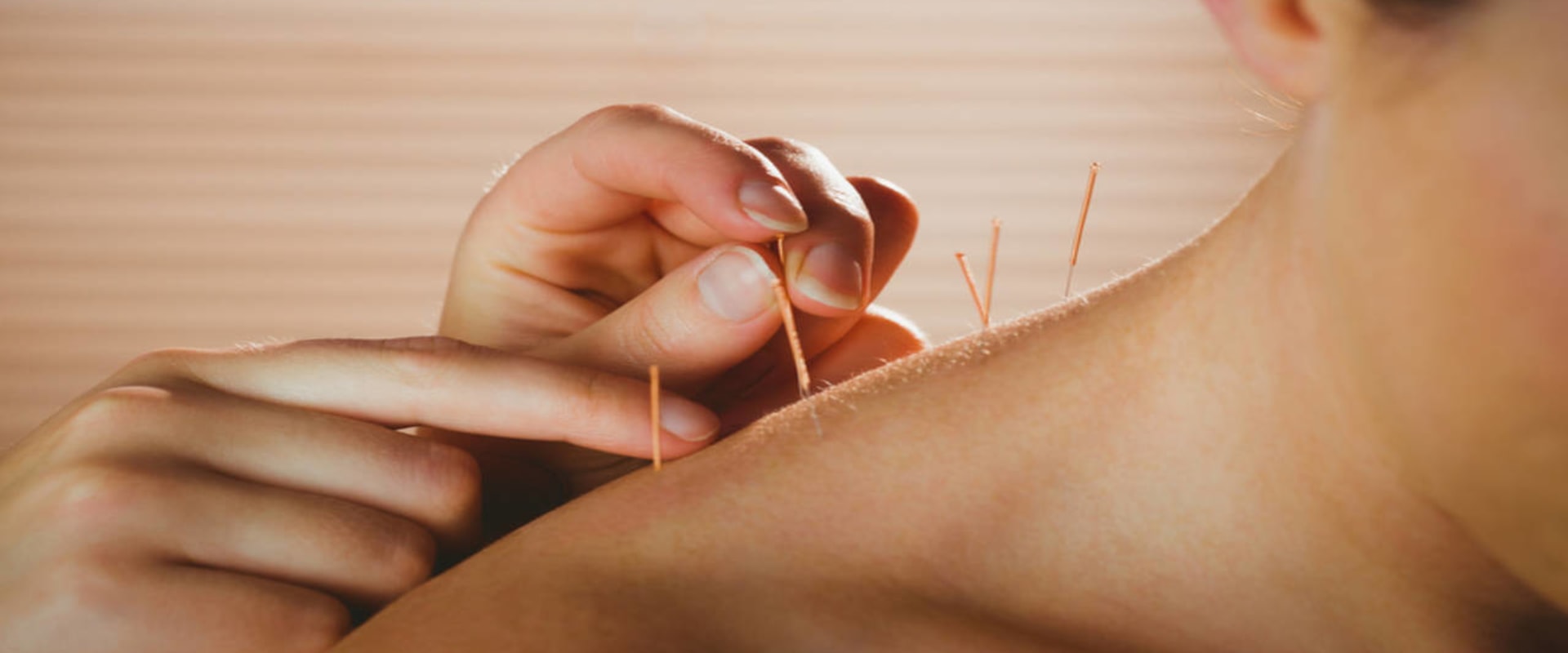 What Should You Do and Not Do After Acupuncture?
