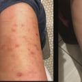 Can I Receive Acupuncture if I Have a Metal Allergy or Sensitivity to Certain Metals?