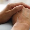 The Negative Effects of Acupuncture: What You Need to Know