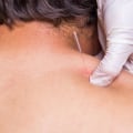 Acupuncture vs Dry Needling: Which is Better for Pain Relief?