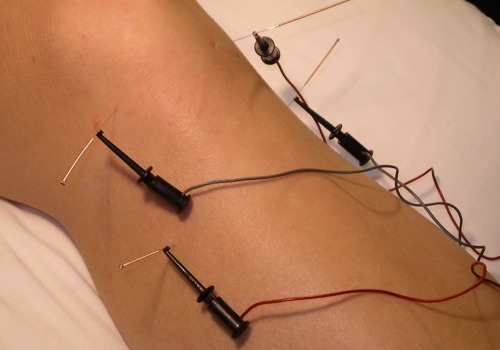 Is it Safe for Patients with Cardiac Pacemakers to Receive Electroacupuncture?