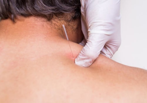 What is Dry Needling and How Does it Differ from Acupuncture?