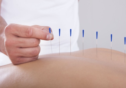 How Long Does Acupuncture Take to Work?