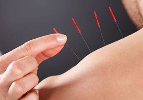 Can I Receive Acupuncture with a Pacemaker or Other Implanted Device?