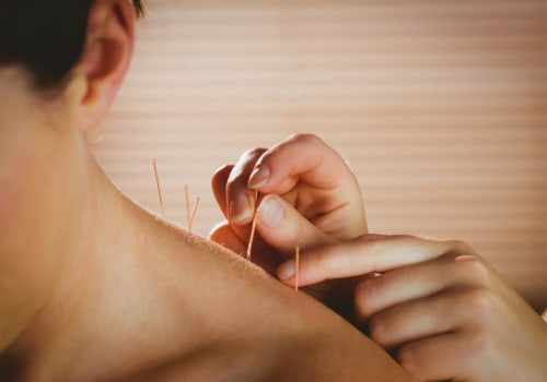 The Risks and Benefits of Acupuncture