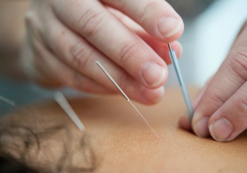 How Long Does an Acupuncture Session Last?